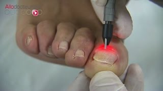 Mycoses des ongles  le traitement au laser  Allô Docteurs [upl. by Paloma]