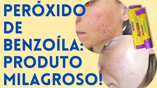 Peróxido de Benzoíla  Produtos para Acne que FUNCIONAM EP 01 🙌🏻 [upl. by Netsua]