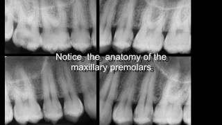 Three rooted maxillary premolars [upl. by Keisling]