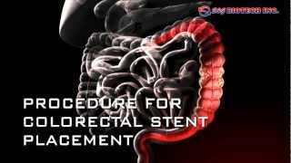 Colorectal Stent [upl. by Morel]