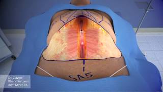 Dr Claytor Demonstrates Drainless Tummy Tuck with Liposuction  3D Animation [upl. by Ahtera]