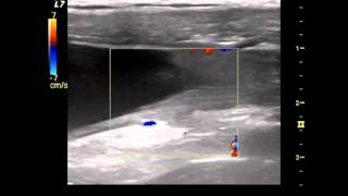 A video ultrasound scan of urine entering the bladder [upl. by Opaline]