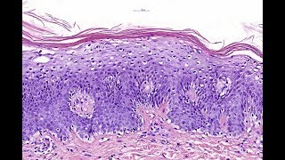 Acrodermatitis enteropathica Phillip H McKee Antonina Kalmykova  CSD Health Care [upl. by Netnilc]