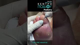 Toe Callus RemovalΑφαίρεση κάλου δακτύλου footpain κεντροποδιου feet foot callus podiatrist [upl. by Beck]