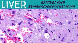 Rare Liver Tumor  Epithelioid hemangioendothelioma Basic soft tissue pathology [upl. by Heck]