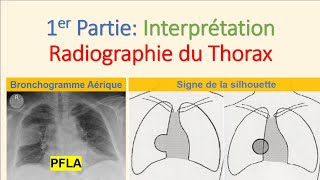 Interprétation Téléthorax N°01 Radiographie du Thorax Syndrome Alvéolaire Pneumologie imagerie PFLA [upl. by Annecorinne]