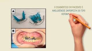 Amelogênese Imperfeita [upl. by Gnehc]