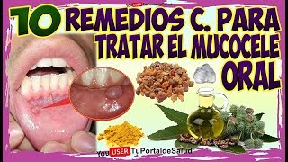 10 Remedios Caseros para Tratar el Mucocele Oral [upl. by Eirek]