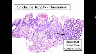 2021 Classic Lectures in Pathology What You Need to Know Gastrointestinal Pathology [upl. by Perreault]