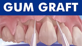 Gum graft  Coronally advanced flap  Receding gums treatment © [upl. by Nybbor]