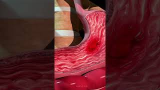 Formation of an Ulcer in the Stomach [upl. by Romelle88]