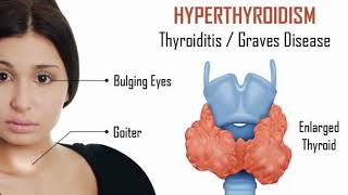 clinical case presentation Hyperthyroidism or Graves disease [upl. by Peggy]