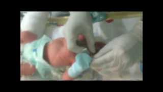 Neonatal Digital Intubation Part 1 [upl. by Atalante]