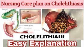 Nursing care plan on Cholelithiasis NCP on CholelithiasisNursing process with nursing diagnosis [upl. by Aneerhs]