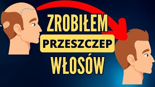 Przeszczep włosów  a po co to komu [upl. by Placia87]