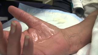 Trigger Finger Injection Therapy [upl. by Searcy569]