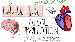 Atrial Fibrillation Made Easy Complete Overview [upl. by Alad]