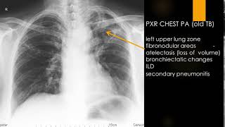 CASE 629 TB left upper lung old tuberculosis fibronodular areas [upl. by Nemaj]