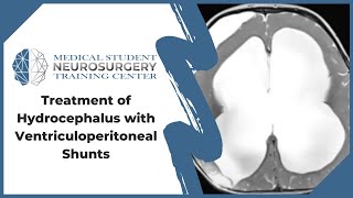 Treatment of Hydrocephalus with Ventriculoperitoneal Shunts [upl. by Dotti]