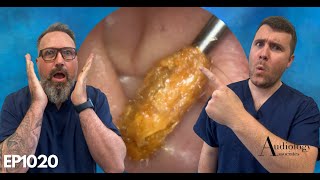 EAR WAX PLUG REMOVAL EAR CANAL CHOLESTEOTOMA AND OPINION ON THE RAI HOOK  EP1020 [upl. by Ilka]