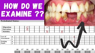 PERIODONTAL EXAMINATION ‖ HOW TO EXAMINE PERIODONTITIS PATIENT  ‖ PERIO HUB ‖ Dr SNEHA [upl. by Odareg]