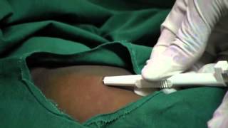 Contraceptive Implants  11  Procedure Insert implant [upl. by Aleedis]