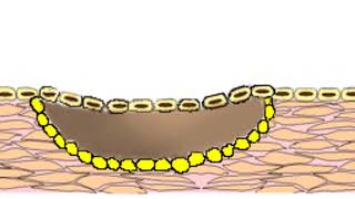 Osteitis Condensante [upl. by Beatty]