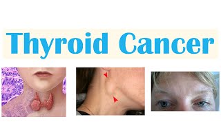 Thyroid Cancer Papillary Follicular Medullary amp Anaplastic  Symptoms Diagnosis Treatment [upl. by Jangro850]