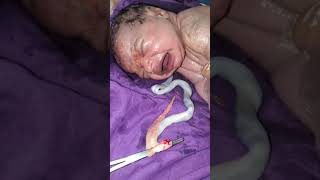 Vernix lot of 2 meters Newborn baby nurse and doctor cleaning it with soap and spinal cords cutt [upl. by Eatnoj864]