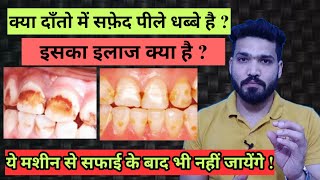 दाँतो के सफ़ेद पीले धब्बे कैसे साफ होंगे  dental fluorosis [upl. by Aigroeg]