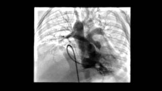 Tetralogy of Fallot RV Angiogram [upl. by Eloise]