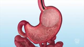 Intragastric Balloon for Weight Loss  Mayo Clinic [upl. by Ohare]