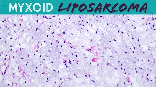 Myxoid Liposarcoma explained in 5 minutes basic soft tissue pathology sarcoma pathologists [upl. by Ardnekan]