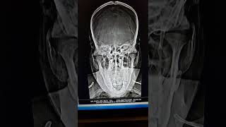 xray styloid process radiography [upl. by Yak32]