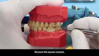 RelyX U 200 cementation on zirconia crown [upl. by Nivan]