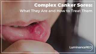 Complex Canker Sores What They Are and How to Treat Them [upl. by Liatrice752]