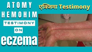 Atomy Hemohim Testimony on eczema  एक्जिमा Testimony [upl. by Aissatan]