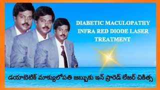 DIABETIC MACULOPATHY INFRA RED DIODE LASER TREATMENT  DrBSUBBARAO [upl. by Annoyek992]