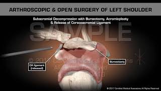 Arthroscopic amp Open Surgery of Left Shoulder [upl. by Goodhen306]