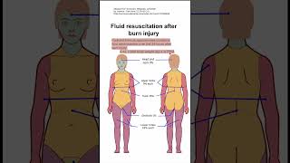 Fluid resuscitation after burn injury [upl. by Noni282]