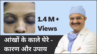 आंखों के काले घेरे  कारण और उपाय Under Eye Dark Circles Causes amp Treatments  In HINDI [upl. by Rora604]