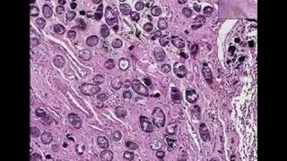 Histopathology Colon rectum Schistosomiasis [upl. by Eskill]