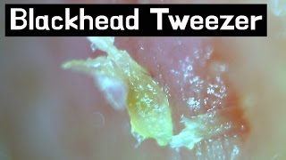 16 Pull out Blackheads  Whiteheads Close up 300X  Blackheads Removal [upl. by Dorreg]