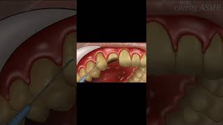 Tooth extraction animationdental implant surgerytreatmentanimation animation asmrvideo asmr [upl. by Hsur]