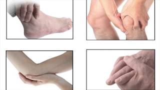 Treatment for Gout [upl. by Candice546]