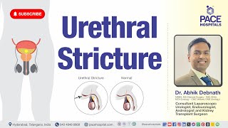 Urethral Stricture  Type Cause Symptoms Complication Diagnosis amp Treatment [upl. by Straub]