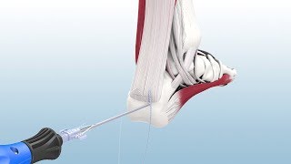 Haglunds Excision and Achilles Reconstruction Using the CuffLink™ System  CONMED Animation [upl. by Koeppel317]