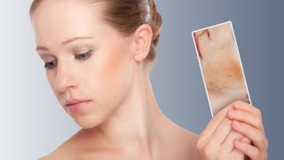 How To Treat Redness amp Rosacea The BEST 5 Ingredients To Reduce Redness Dr Sam Bunting [upl. by Larue]