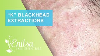 Blackheads Extractions “K’s” 8th Treatment Part 2 [upl. by Godfrey770]