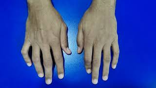 Flexion and Boutonniere Deformities in Rheumatoid Arthritis [upl. by Ahsael518]